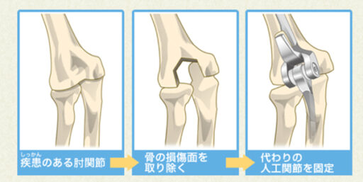 プレスフィット橈骨頭関節形成術の写真