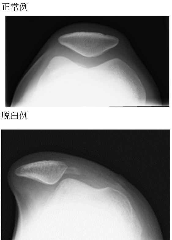 膝蓋骨脱臼に対する治療 聖マリアンナ医科大学 横浜市西部病院