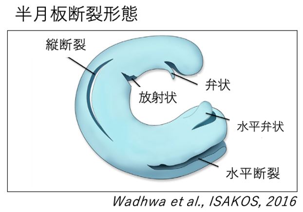 関節鏡下半月板縫合術 | 聖マリアンナ医科大学 横浜市西部病院